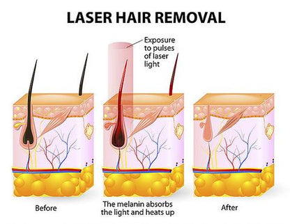 Nouveau Dispositif d'Épilation Laser et Rasoir