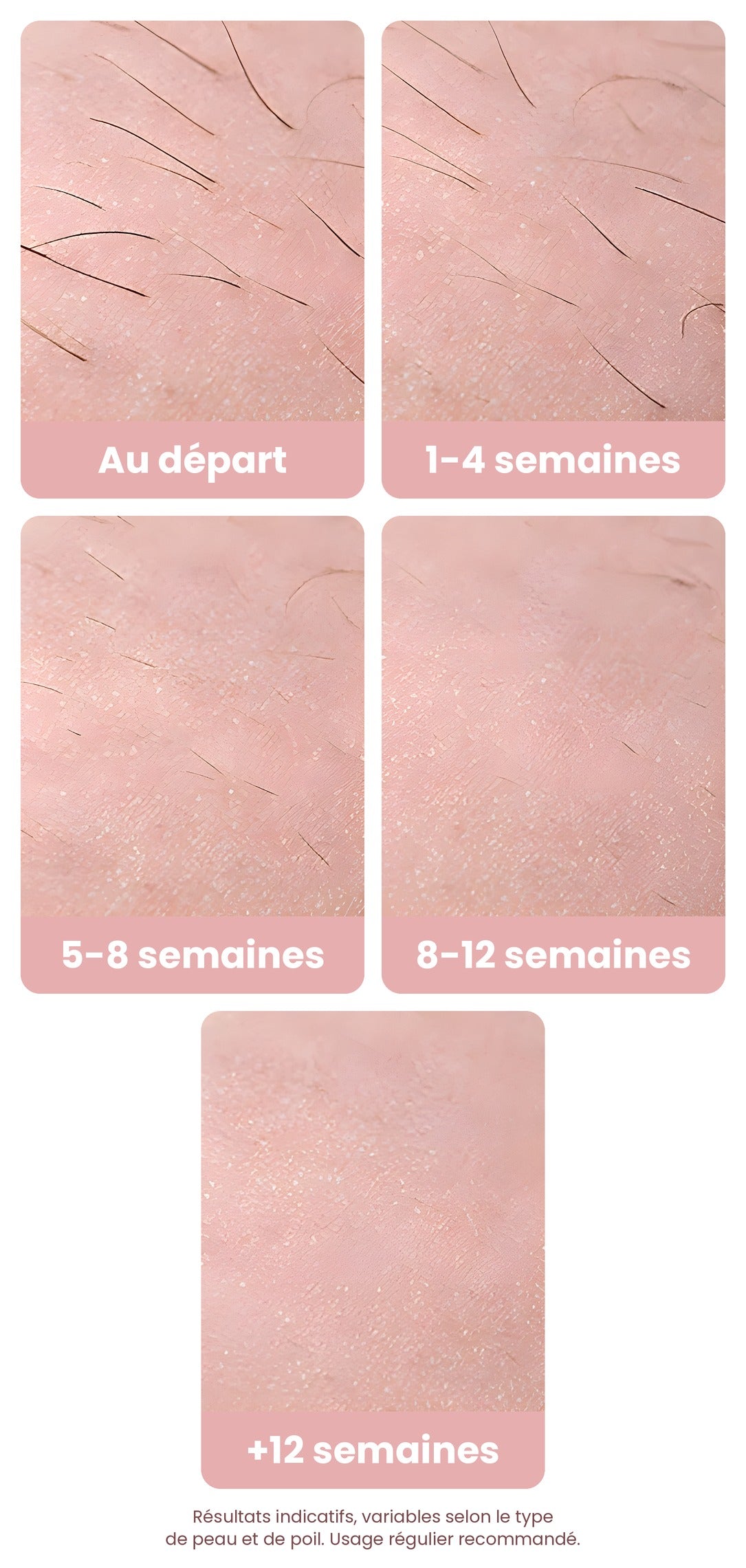 Évolution de la repousse des poils avec l'épilateur BAGOO, de 1 à plus de 12 semaines